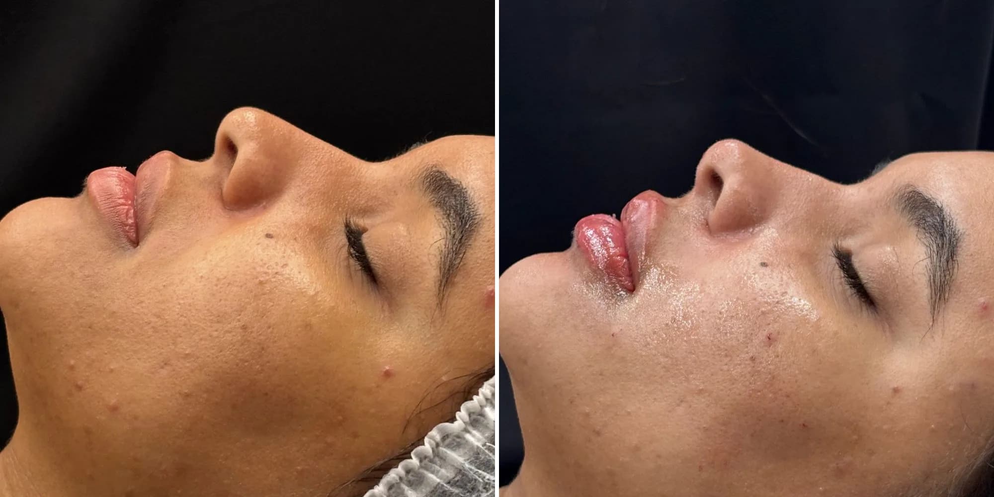 Perfiloplastia