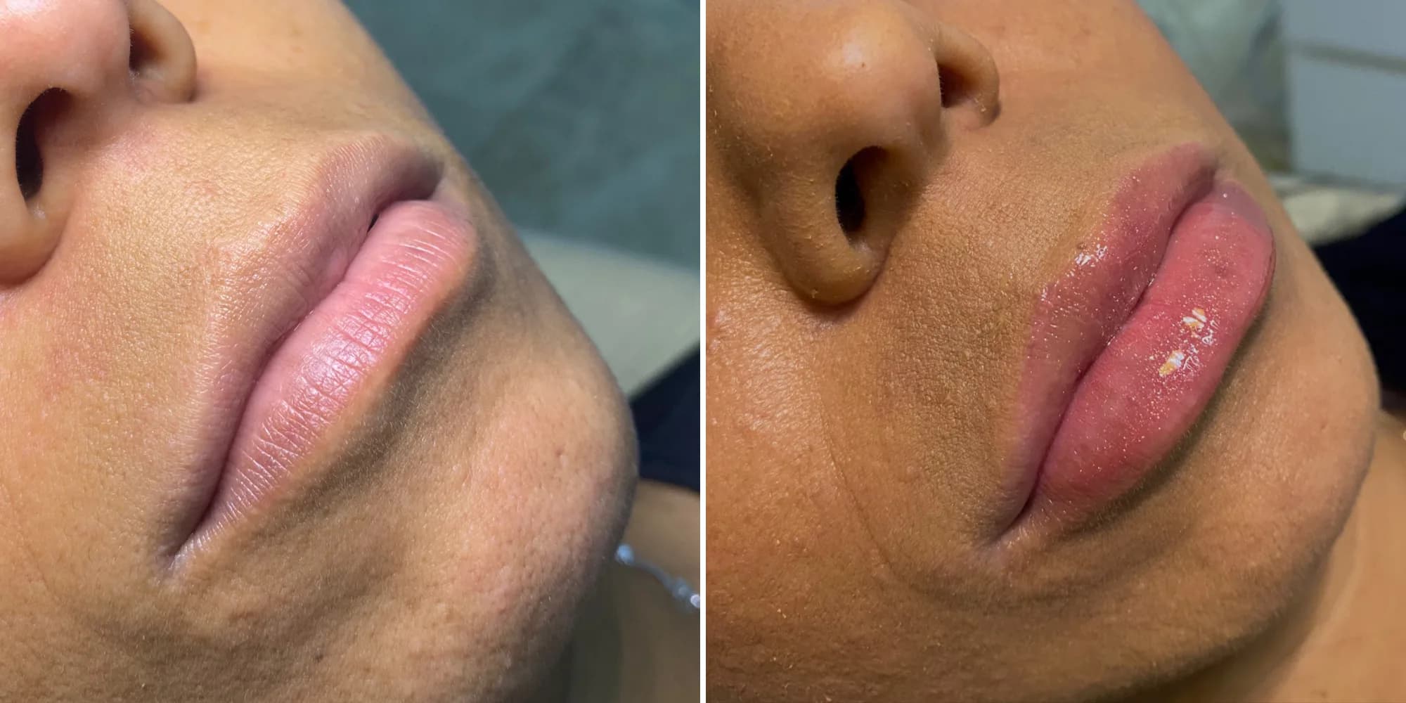 Preenchimento Labial